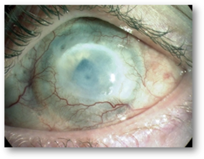 CORNEA INJURED BY CHEMICAL BURNT WHICH HAS DEVELOPED OPACITY AND NEOVASCULARISATION. AUTHOR: SECKER, G.A., AND DANIELS, J.T.