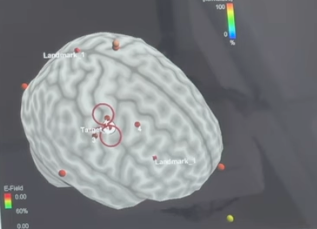 Image of a brain scan on a screen with various markers