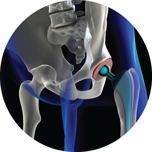 Image of a Hip Joint