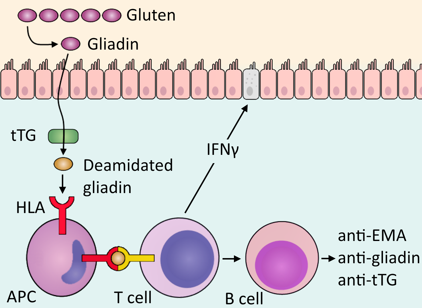 Coeliac disease OverPath
