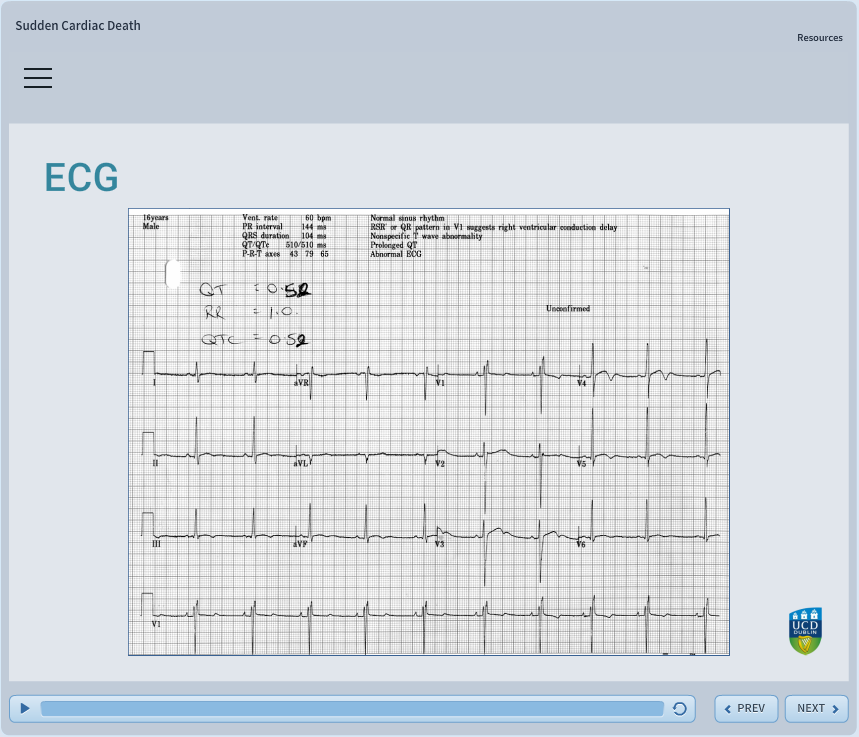 ECG