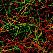 Candida species growing as biofilms on catheter material