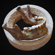Malocclusion and dental crowding arose 12,000 years ago with earliest farmers, study shows