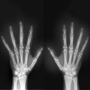 Gene regulating severity of tissue damage caused by rheumatoid arthritis discovered by scientists
