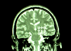 The positioning of the region of interest in the brain - over the left posterior hippocampus