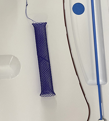 Picture of a stent used in the procedure to open up Maestro's urethra