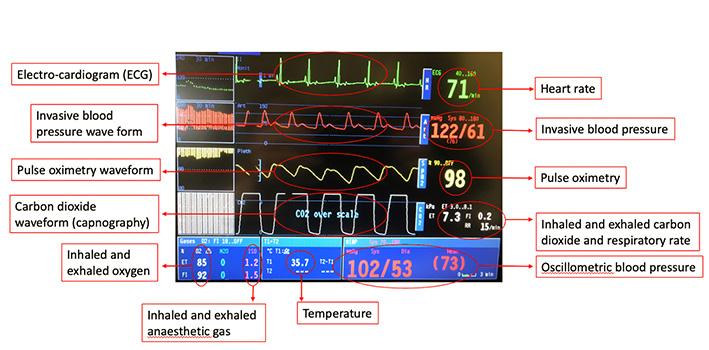 Graphic of anaesthesia monitoring equipment with labels indicating purpose of each section